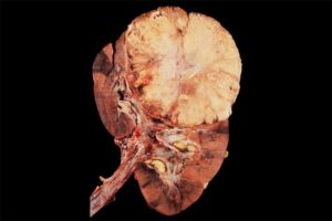 Нарост на почке что это