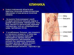 Нарушение оттока мочи из почки лечение