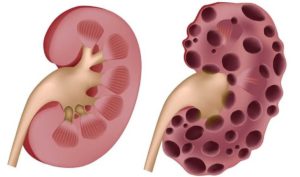 Осложнения на почки после отравления