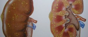 Острый пиелонефрит у кота лечение