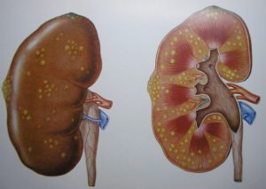 Острый серозный пиелонефрит