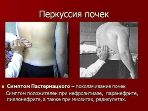 Перкуссия почек в норме