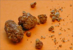 Песок из почек выходит болезненно