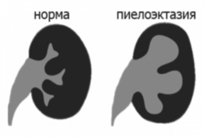 Пиелоэктазия почек у новорожденного слева