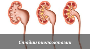 Пиелоэктазия почек у новорожденного слева