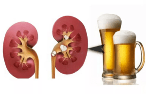 Пиво при пиелонефрите