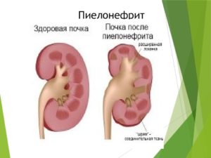 Пиво при пиелонефрите