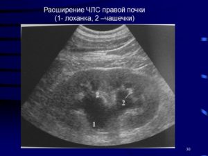 Почему расширяются чашечки в почках