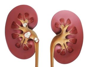 После дробления камней в почках кровь в моче