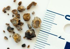 После дробления камней в почках кровь в моче