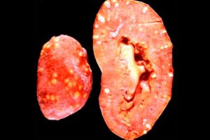 После лечения пиелонефрита снова температура