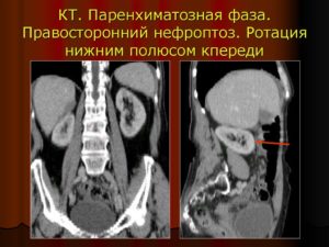 Правосторонний нефроптоз 1