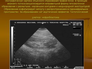 Признаки образования правой почки