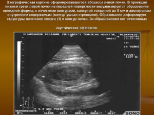 Признаки образования правой почки