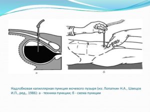 Прокол мочевого пузыря