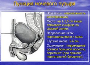 Прокол мочевого пузыря