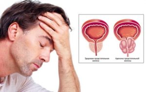 Противопоказания при простатите у мужчин