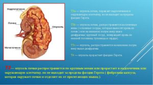 Рак почки мкб