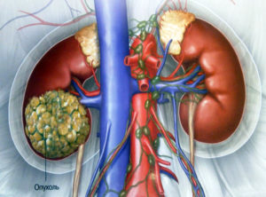 Рак почки мкб