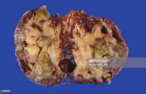 Реально ли растворить камни в почках