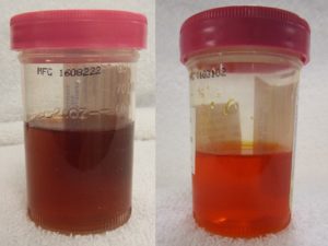 Розовая моча причины