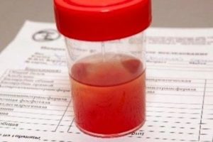 Розовая моча причины