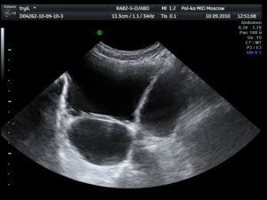 Узи мочевого пузыря у мужчин что показывает