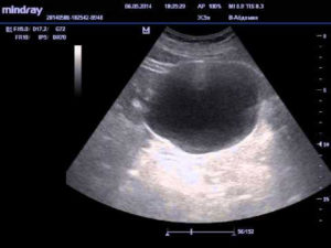 Узи мочевого пузыря у мужчин что показывает