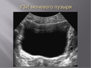 Узи мочевого пузыря у мужчин что показывает