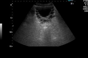 Узи мочевого пузыря у мужчин что показывает