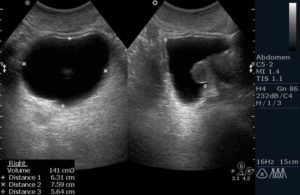 Узи мочевого пузыря у мужчин что показывает