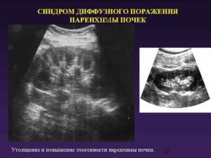 Утолщение паренхимы почек
