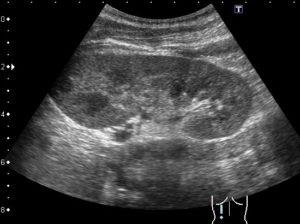 Утолщение паренхимы почек