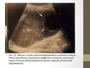 Утолщение паренхимы почек