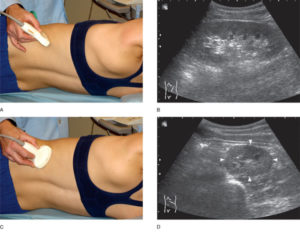 Узи сосудов почек как делают