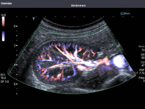 Узи сосудов почек как делают