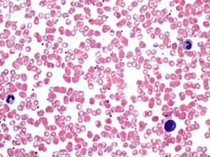 В мазке лейкоциты и эритроциты