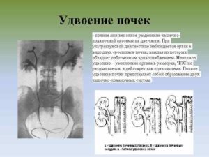 Удвоение почек члс