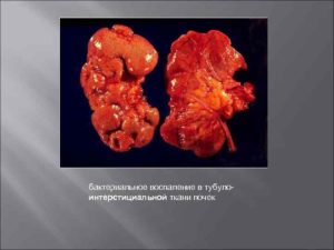 Тубулоинтерстициальный пиелонефрит лечение