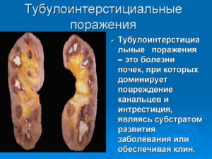 Тубулоинтерстициальный пиелонефрит лечение