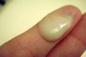 Выделения из уретры при беременности