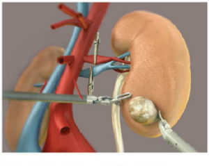 Сколько проживет человек без почки
