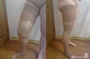 Сколько носить компрессионные чулки после операции на венах