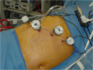 Сколько длится лапароскопическая операция на почке