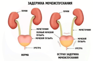Задержка мочеиспускания у женщин в пожилом возрасте лечение