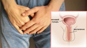 Жжение в уретре после мирамистина