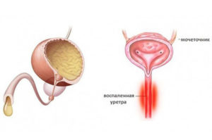 Жжение в уретре после мирамистина