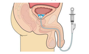 Жжение в уретре после мирамистина