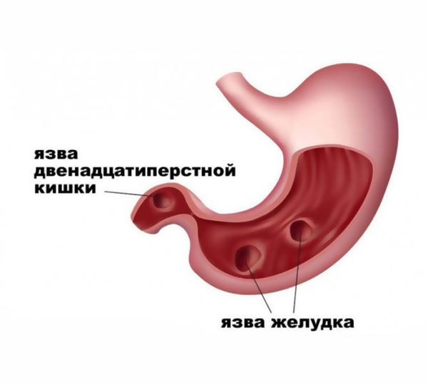 Двенадцатиперстная кишка язвы