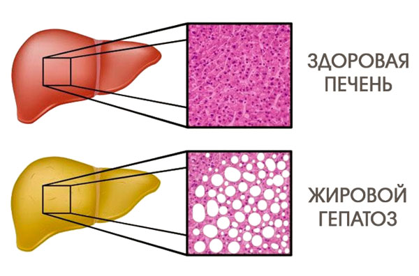 Гипатоз печени